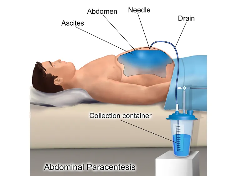 trattamento ascite
