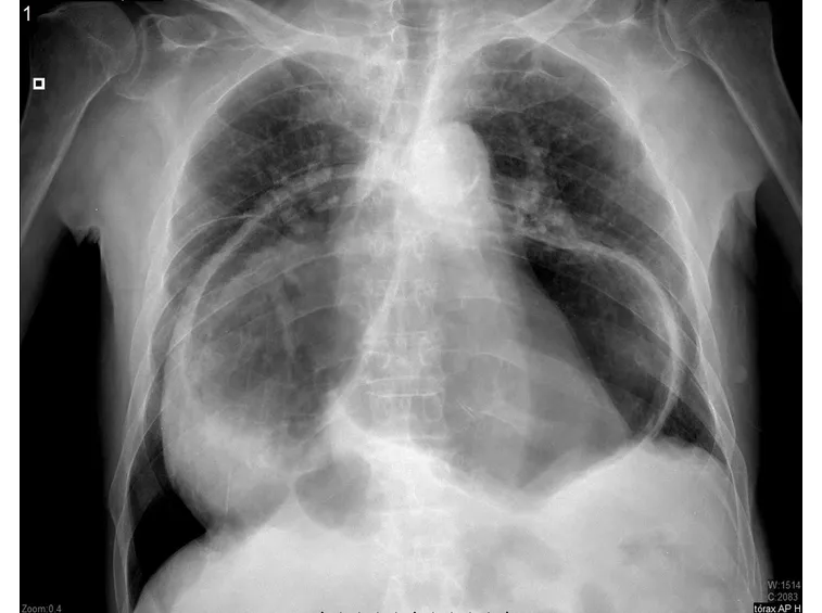 Radiografia di ernia iatale
