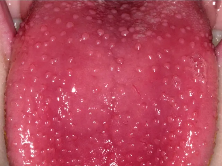 Lingua a fragola
