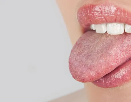 candidosi orale