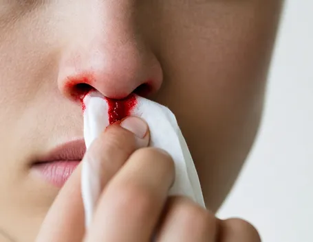 Sangue naso