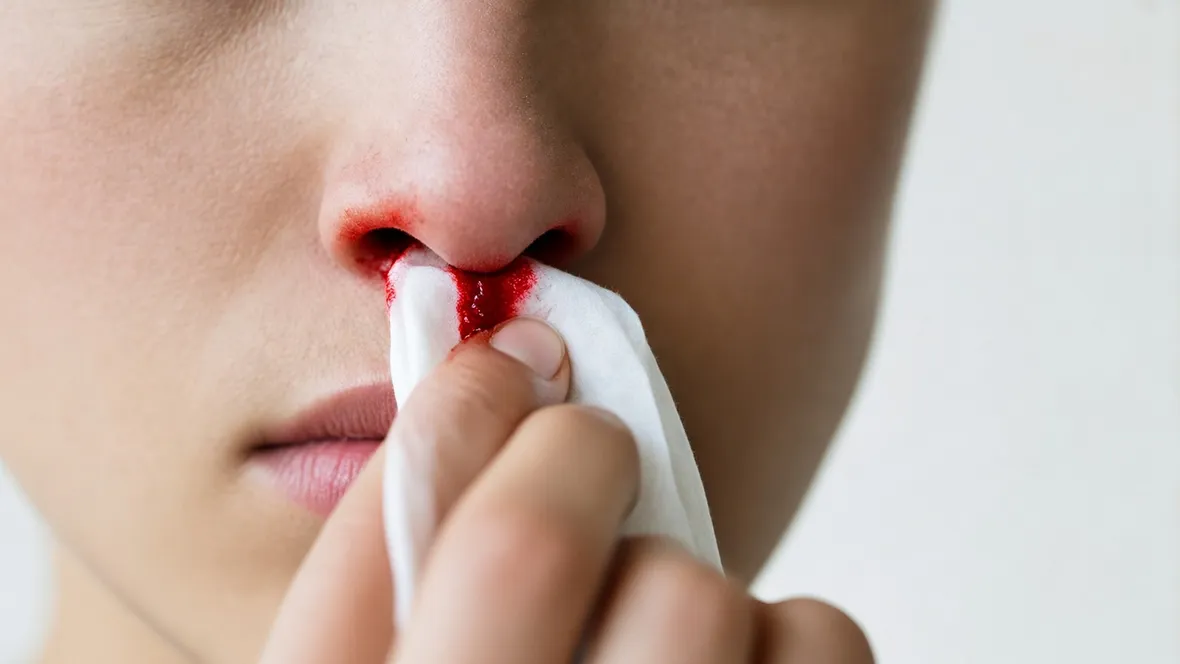 Sangue naso