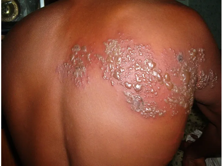 Herpes zoster