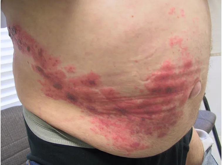 Herpes addominale