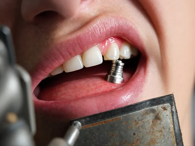 Impianto dentinale