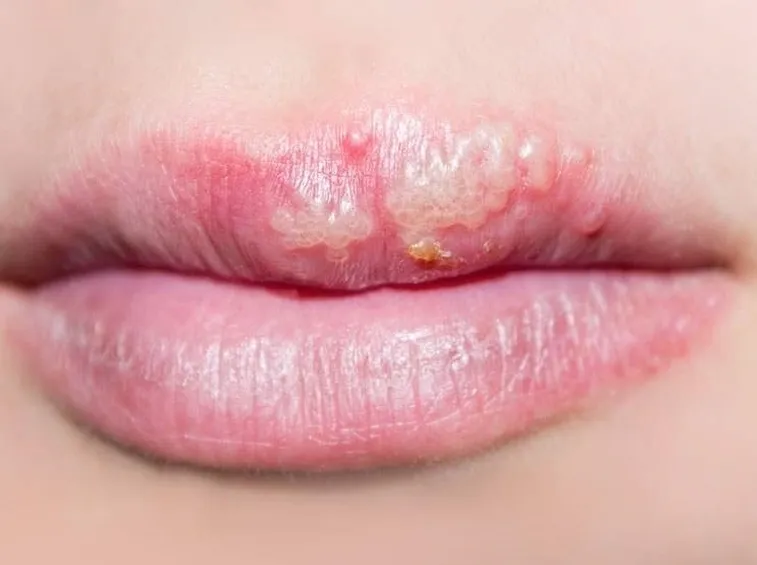 Herpes simplex