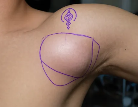 Lipoma ascellare
