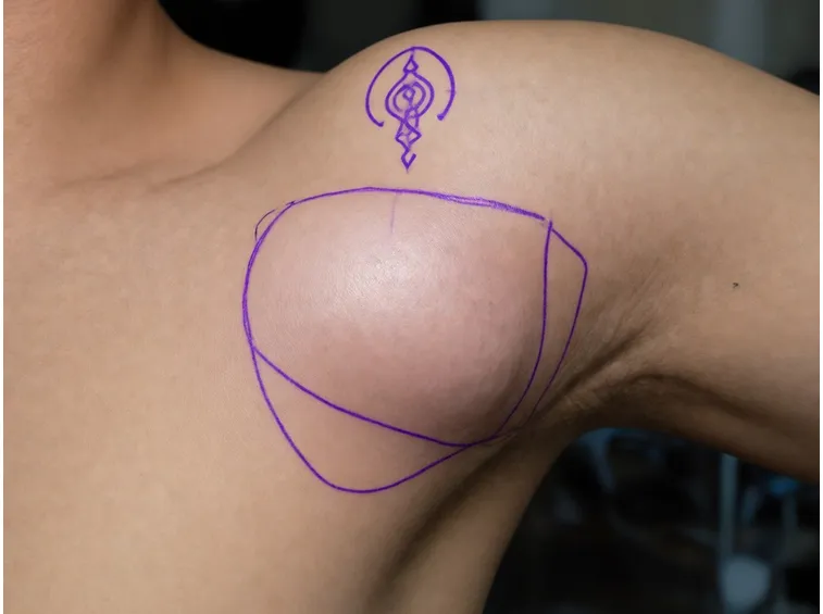 Lipoma ascellare