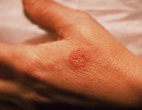 Eczema 