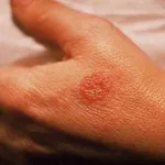 Eczema 