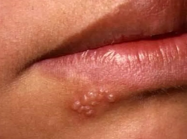 herpes simplex