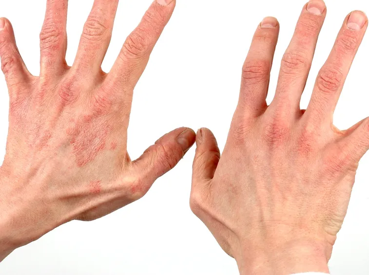 dermatite viso