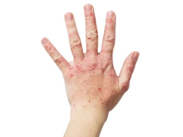 mani con eczema