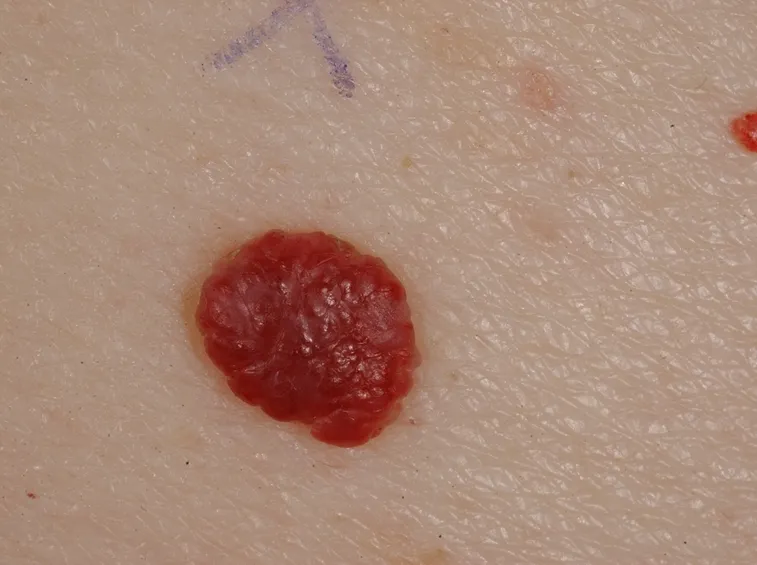 angioma