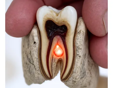 Dente cariato con ascesso