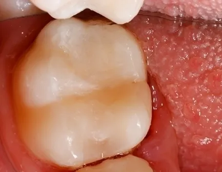 Dente giudizio