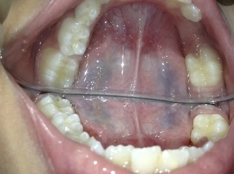 Estrazione dentaria