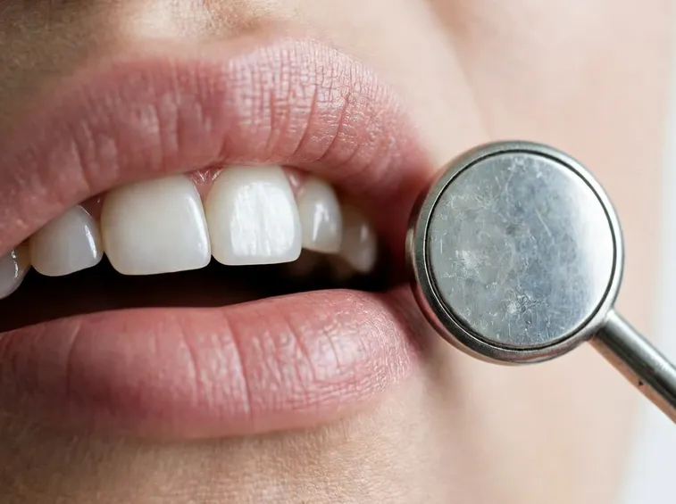 Faccette dentali materiali