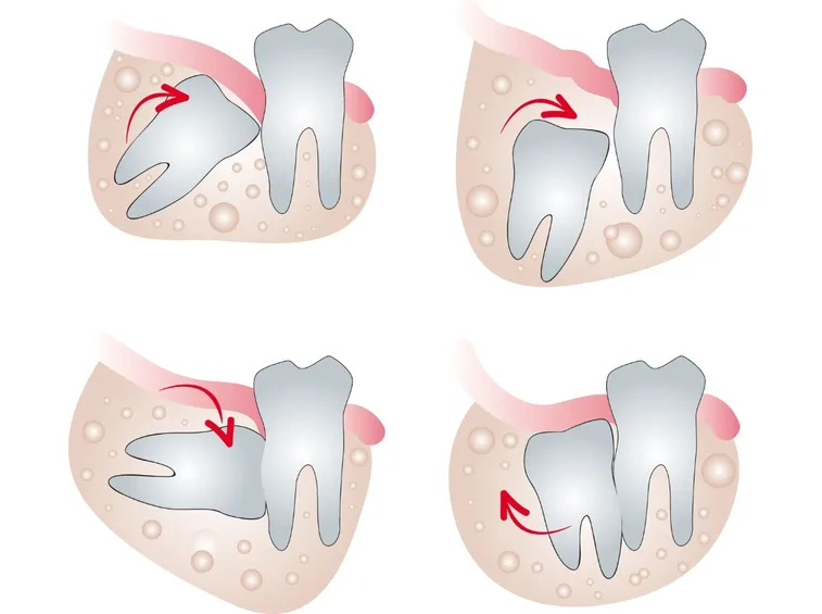 Problemi ai denti del giudizio