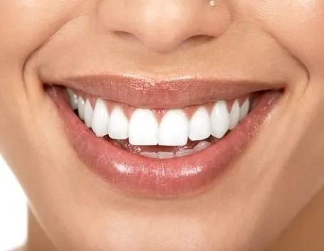 bellezza dei denti