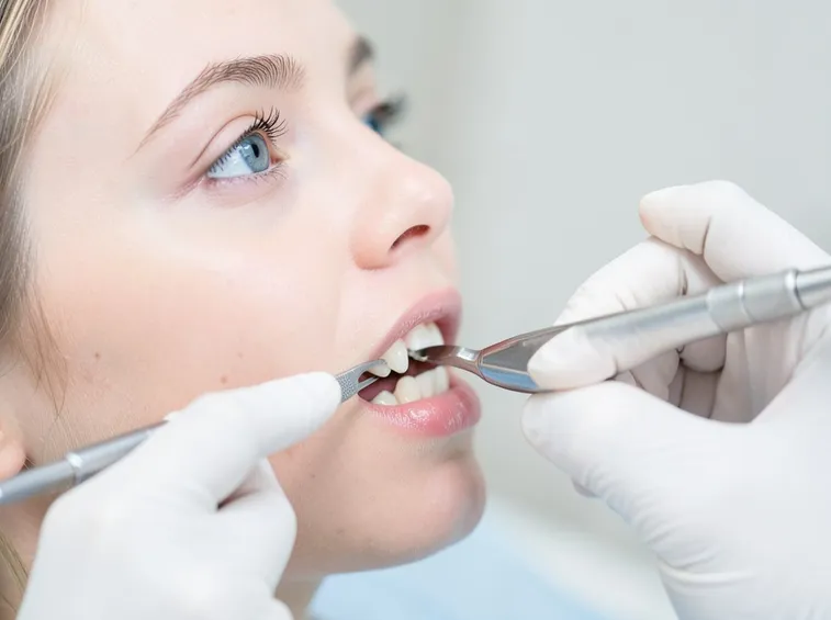 Curare placca dentale