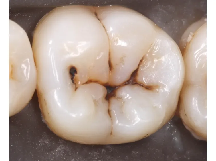 denti da curare