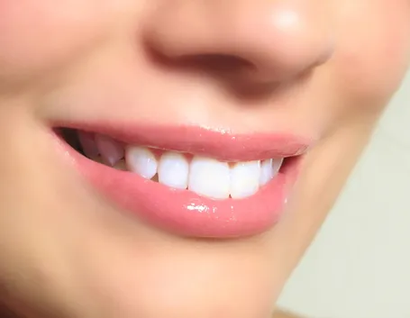sorriso bianco