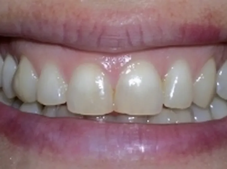 macchie denti
