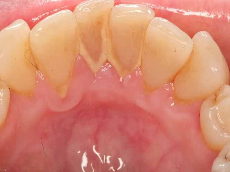 Tartaro dentale