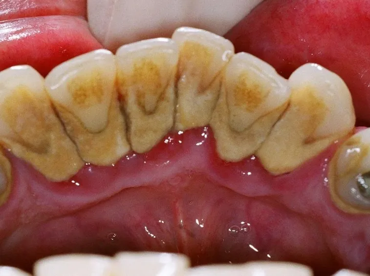 Denti tartaro