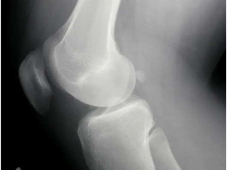 radiografia del ginocchio 