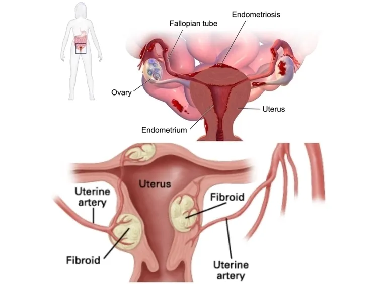 endometriosi