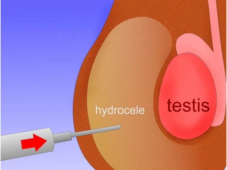 Aspirazione del liquido dell'idrocele