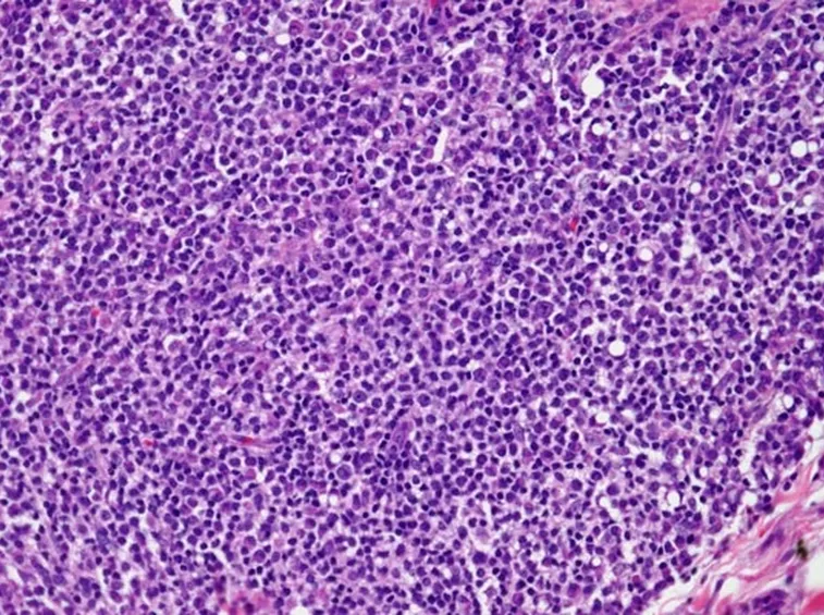 Tessuto canceroso