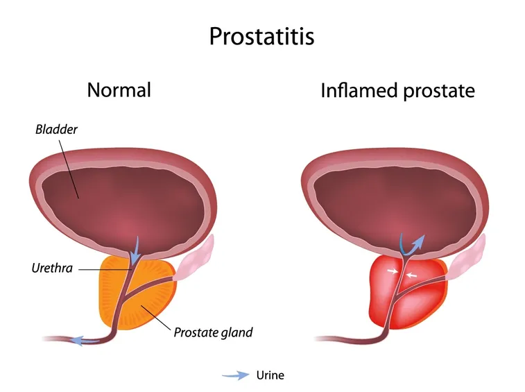 Prostata sana e infiammata