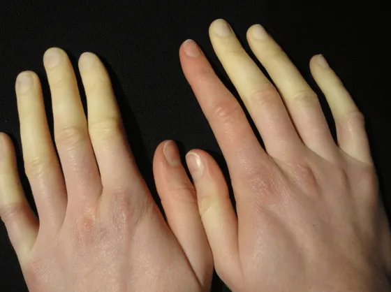 Effetti della patologia sulle dita