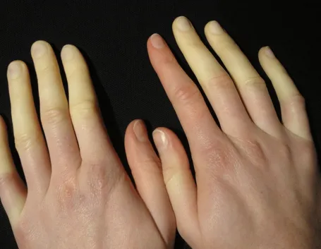 Effetti della patologia sulle dita