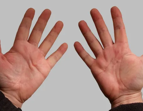 Morbo di dupuytren allo stato iniziale