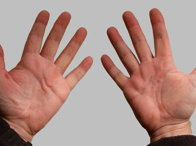 Morbo di dupuytren allo stato iniziale