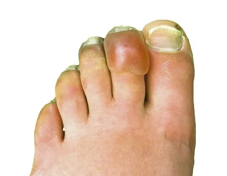 Esempio di cisti tendinea