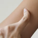 Prurito dermatite