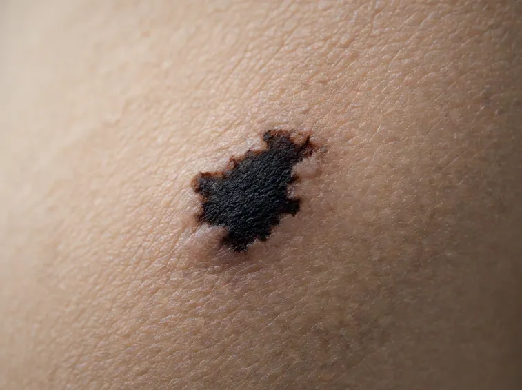 melanoma