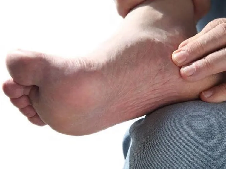 piedi gonfi