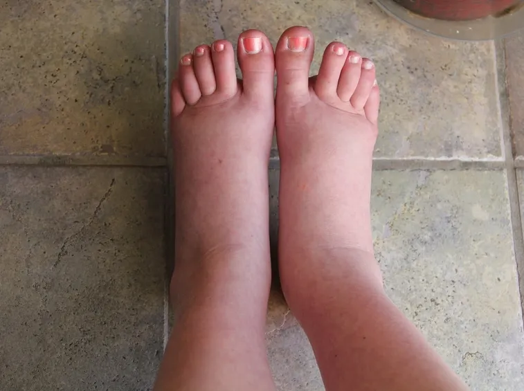 piedi gonfi2