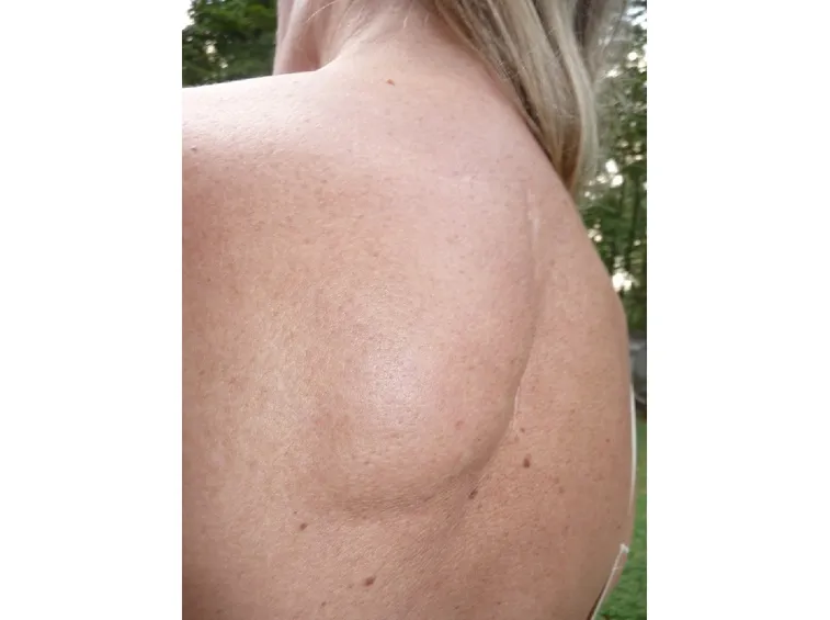 Lipoma schiena