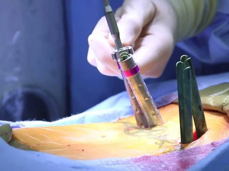 Intervengo rimozione lipoma schiena