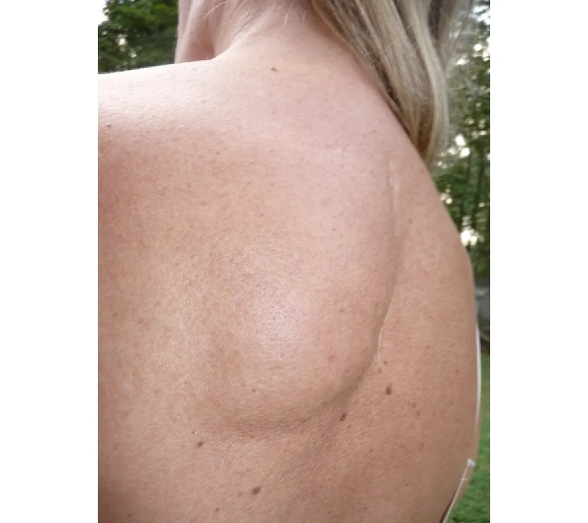Lipoma schiena