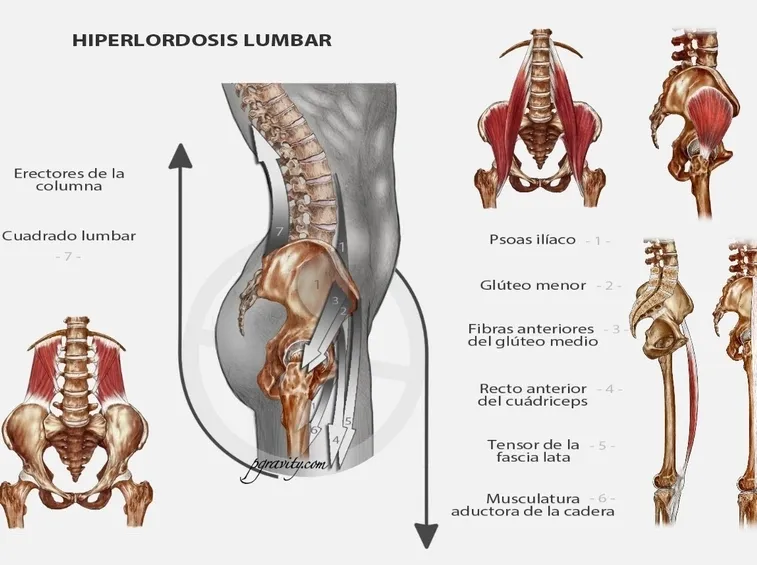 Iperlordosi lombare muscoli interessati
