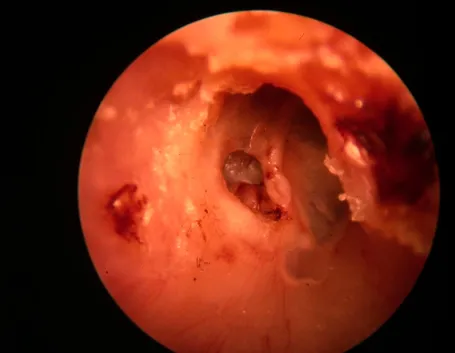 Cavità auricolare infiammata