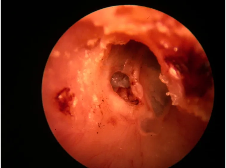 Cavità auricolare infiammata